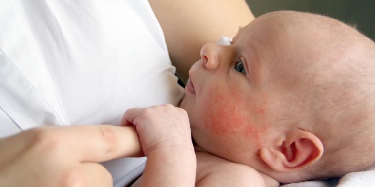 Atopični dermatitis